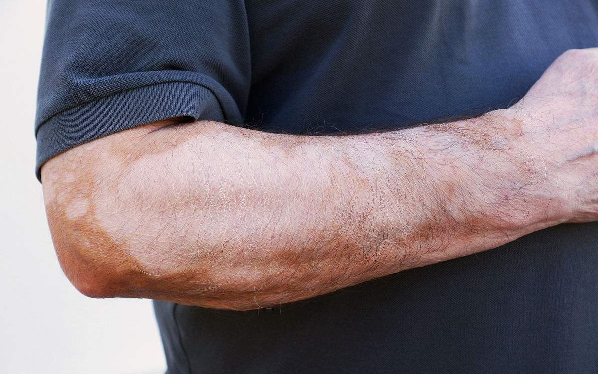 甲醛超標和白癜風有關(guān)系嗎？裝修污染對人體影響極大！