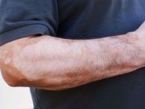 甲醛超標(biāo)和白癜風(fēng)有關(guān)系嗎？裝修污染對(duì)人體影響極大！